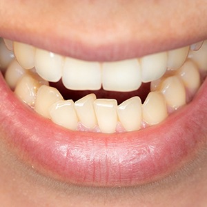Closeup of someone’s teeth with crooked lower arch