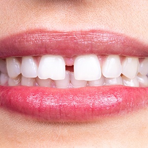 Closeup of someone’s smile with diastema