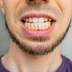 Man with underbite showing teeth with Invisalign and buttons