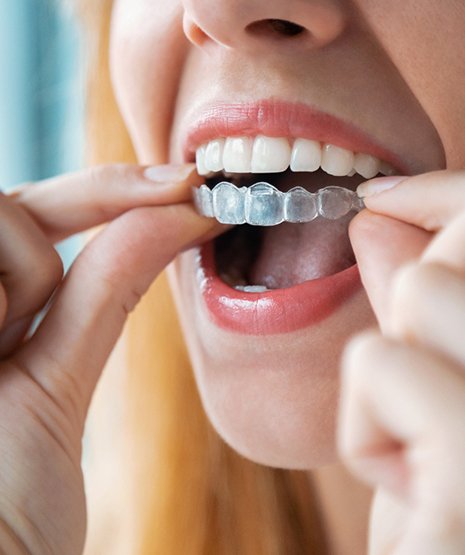 Someone removing Invisalign from upper arch