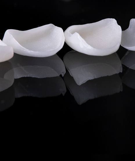Four dental veneers on reflective black surface