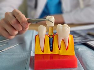 Close-up of dental implant model