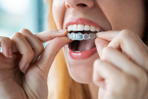 Woman taking Invisalign clear aligner out of mouth